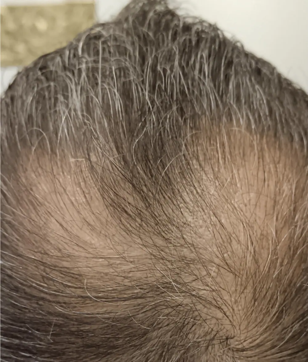 Coronilla antes de la micropigmentación capilar, con zonas de menor densidad