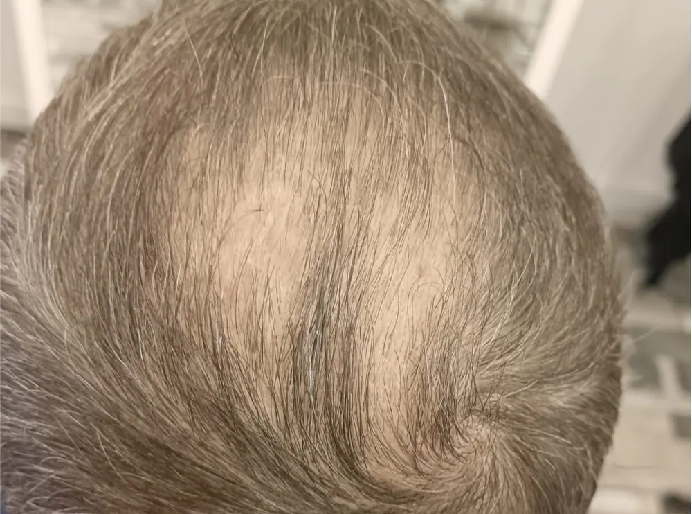 Parte superior de la cabeza antes de la micropigmentación capilar