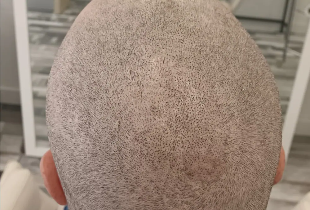 Cabeza vista desde atrás después de la micropigmentación capilar
