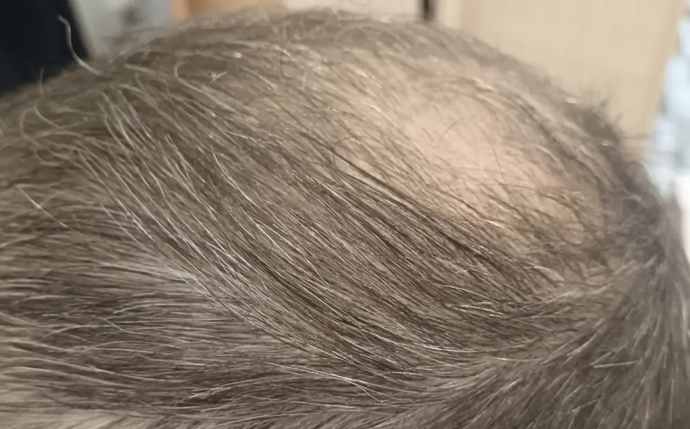 Parte superior de la cabeza antes de la micropigmentación capilar