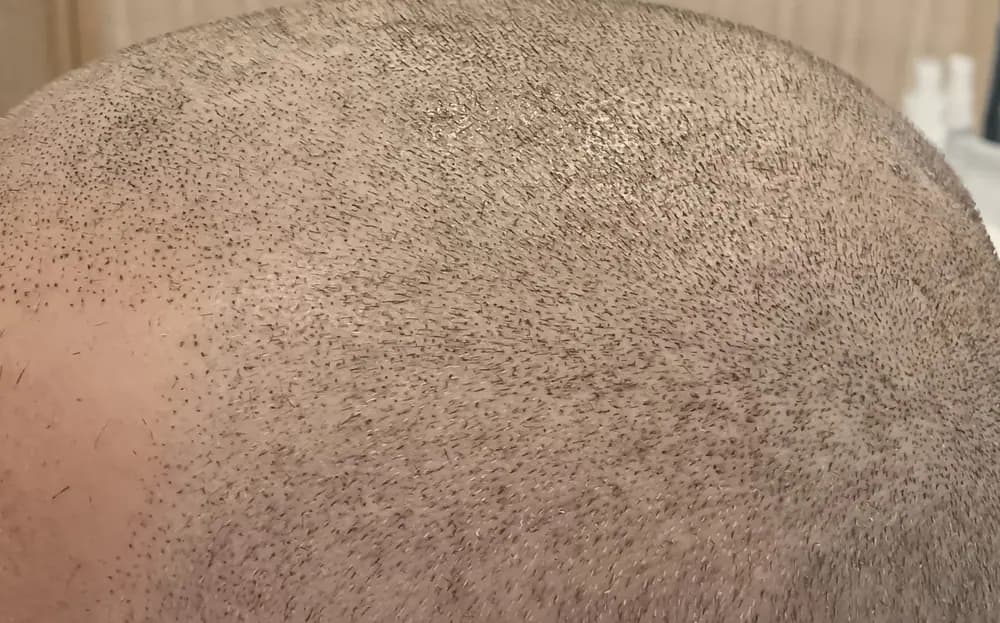 Parte superior de la cabeza después de la micropigmentación capilar