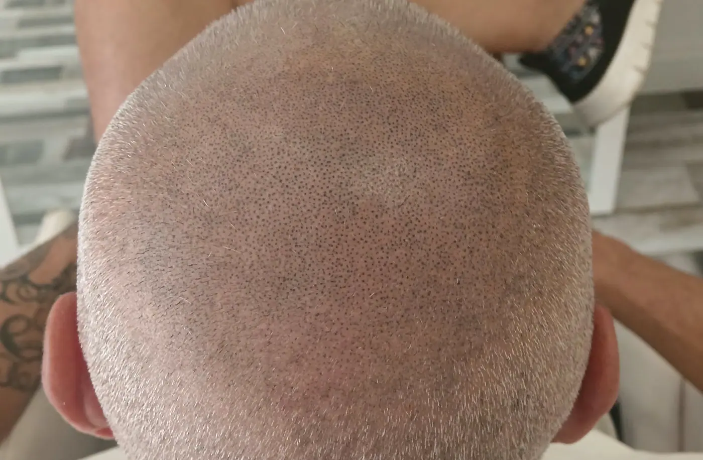 Parte superior de la cabeza de un cliente con micropigmentación capilar, vista desde atrás
