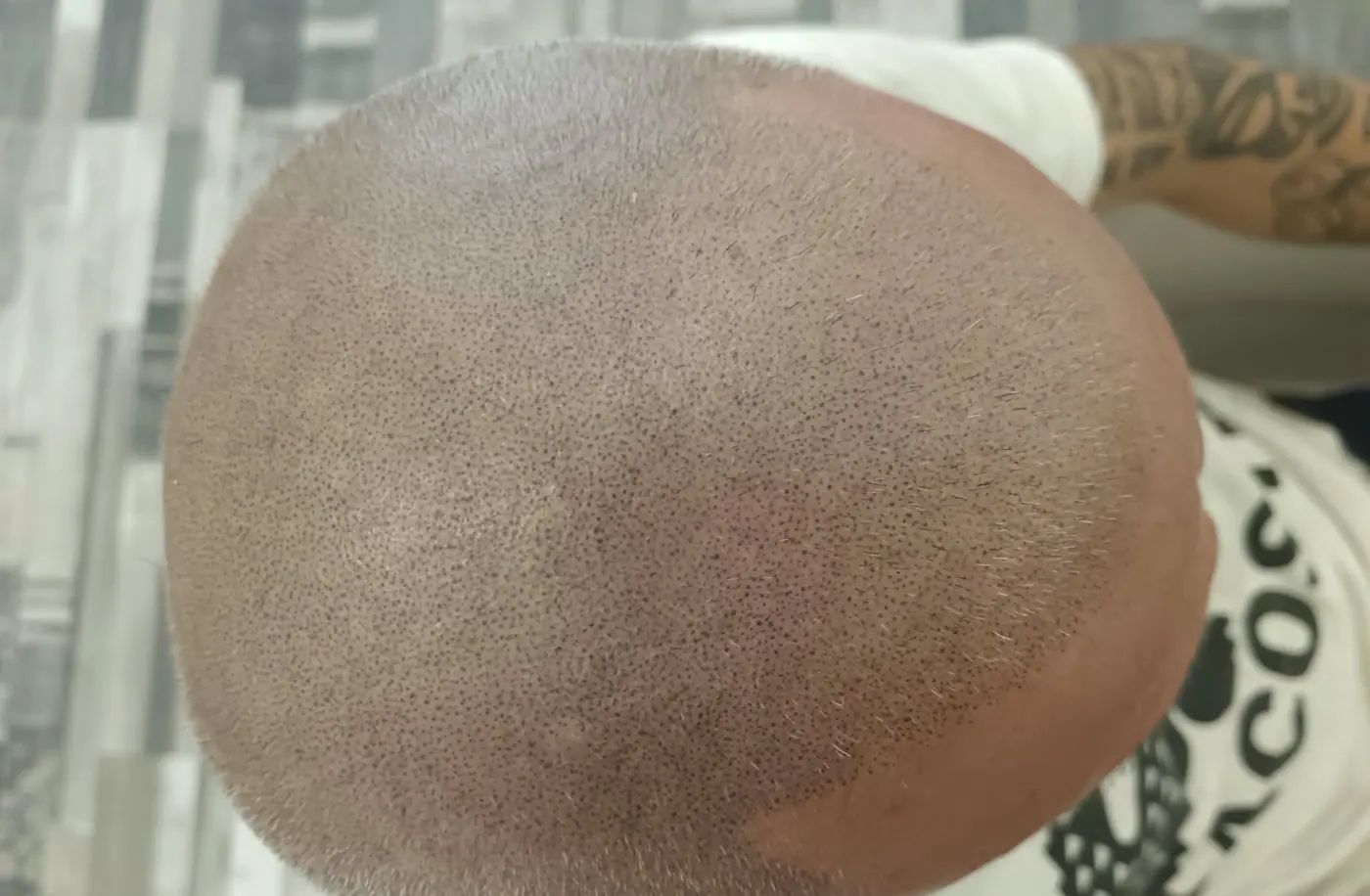 Cabeza de un cliente con micropigmentación capilar, vista desde arriba