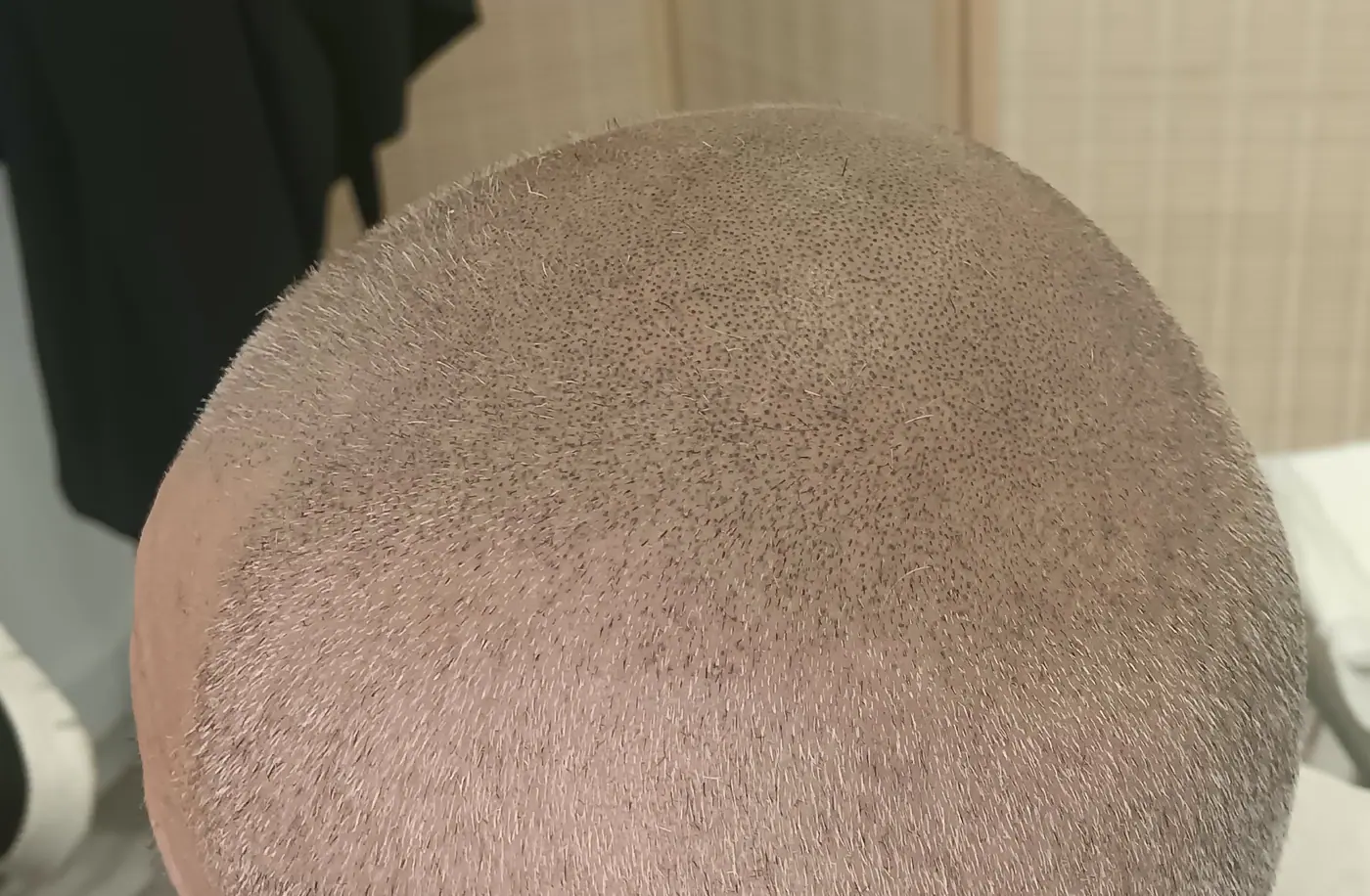 Lateral de la cabeza de un cliente con micropigmentación capilar